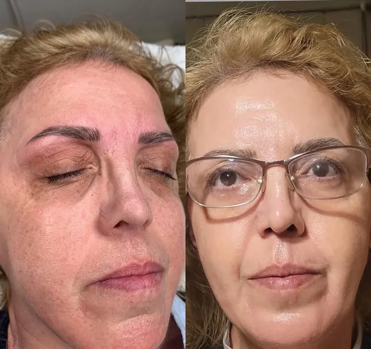 Genius RF · qualité de peau, après 3 séances. · Genius RF Microneedling