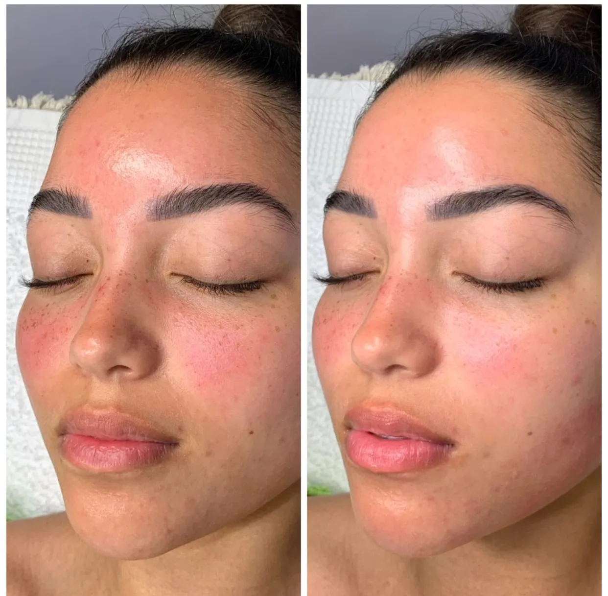 Rougeurs et grain de peau, avant et après une séance. · Hydrafacial