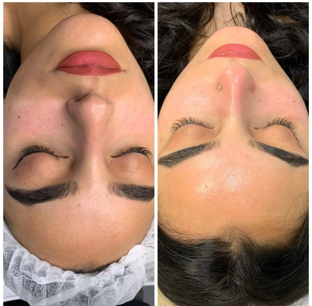 Pores du nez et éclat, avant et après une séance. · Hydrafacial