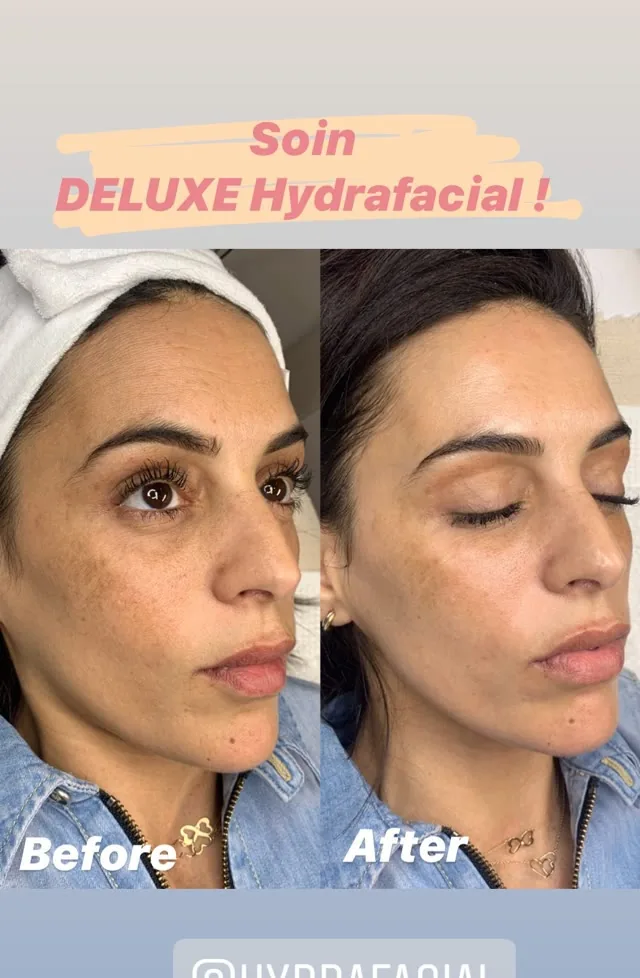 Résultat Hydrafacial