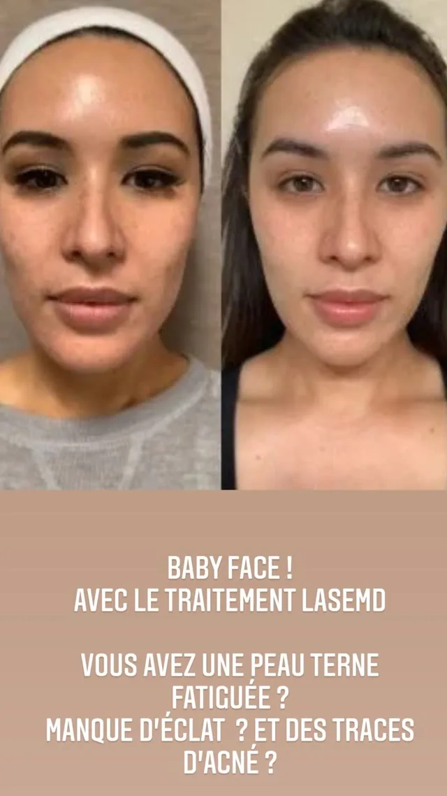 Résultat Laser LaseMD