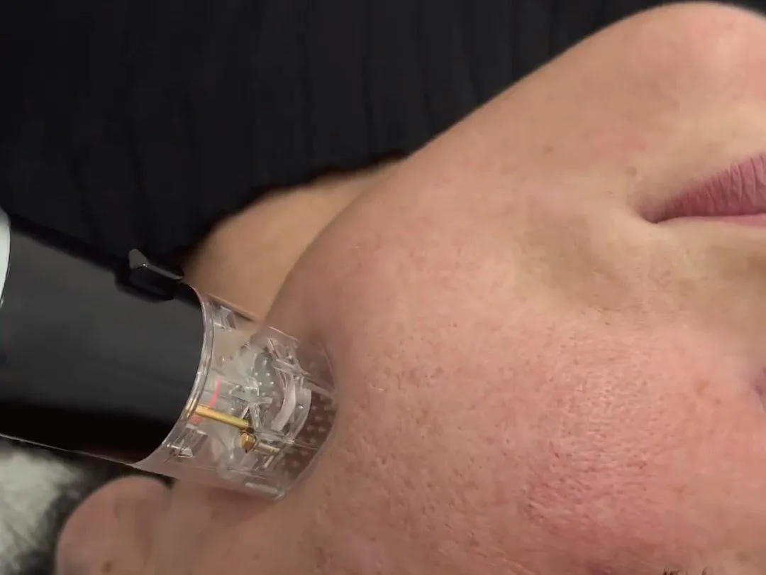 Relâchement de la peau : raffermir sans chirurgie (HIFU, Genius RF)