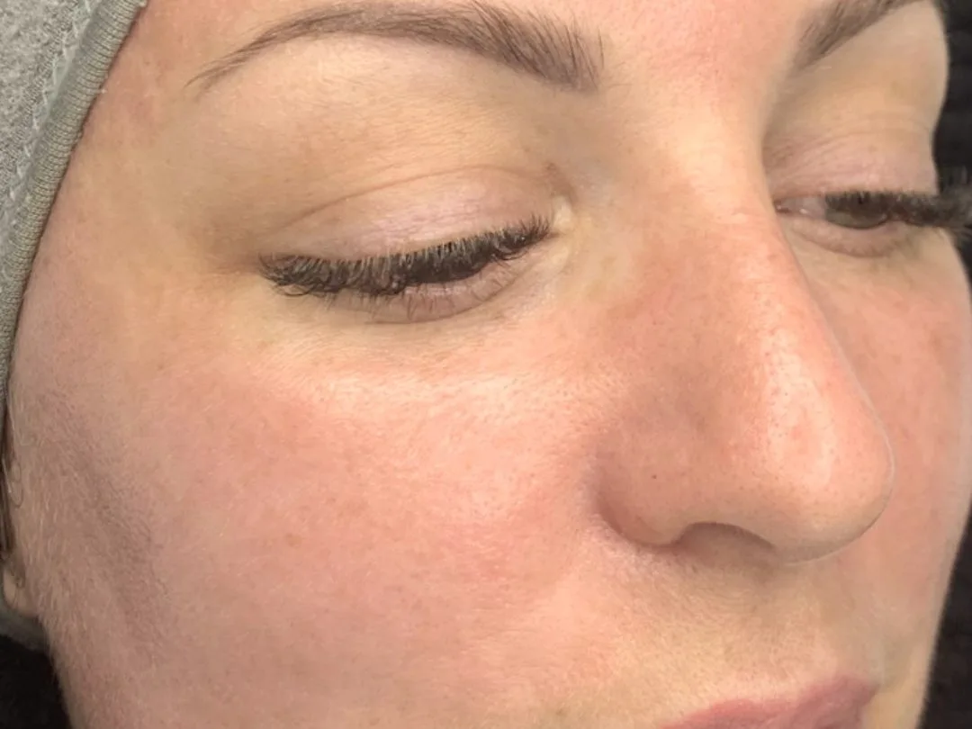 Taches brunes et pigmentation : comprendre et les traiter durablement
