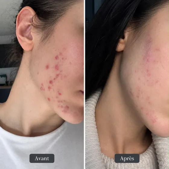 Acné inflammatoire, avant et après