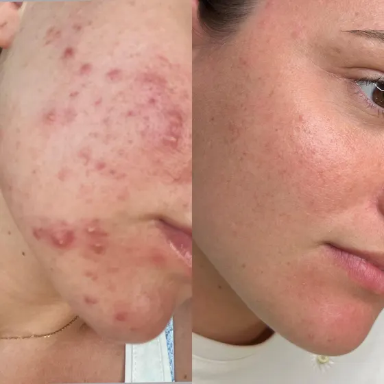 Acné hormonale, avant et après
