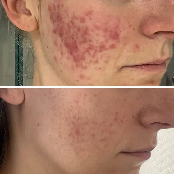 Acné hormonale (ovaires polykystiques), avant et après