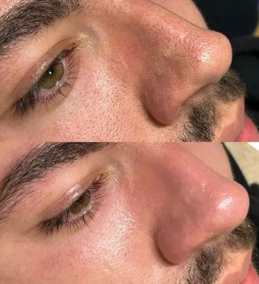 Grain de peau et pores, avant et après