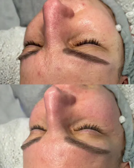 Pores resserrés, éclat, avant et après