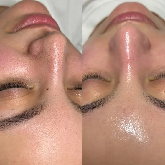 Pores et grain de peau, avant et après