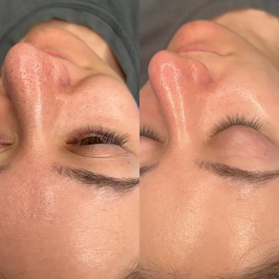 Pores dilatés du nez, avant et après