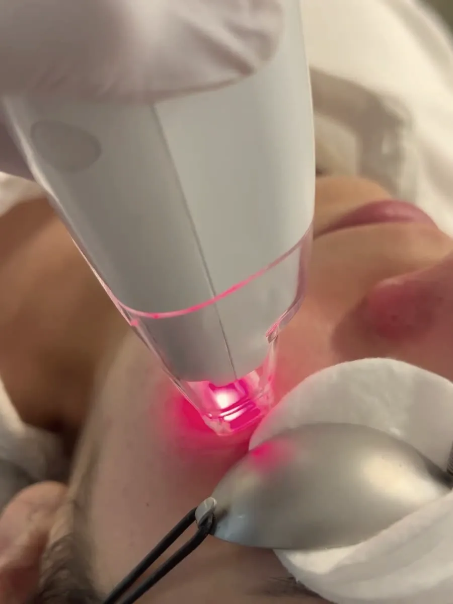 Laser LaseMD en cabine chez House of Highline